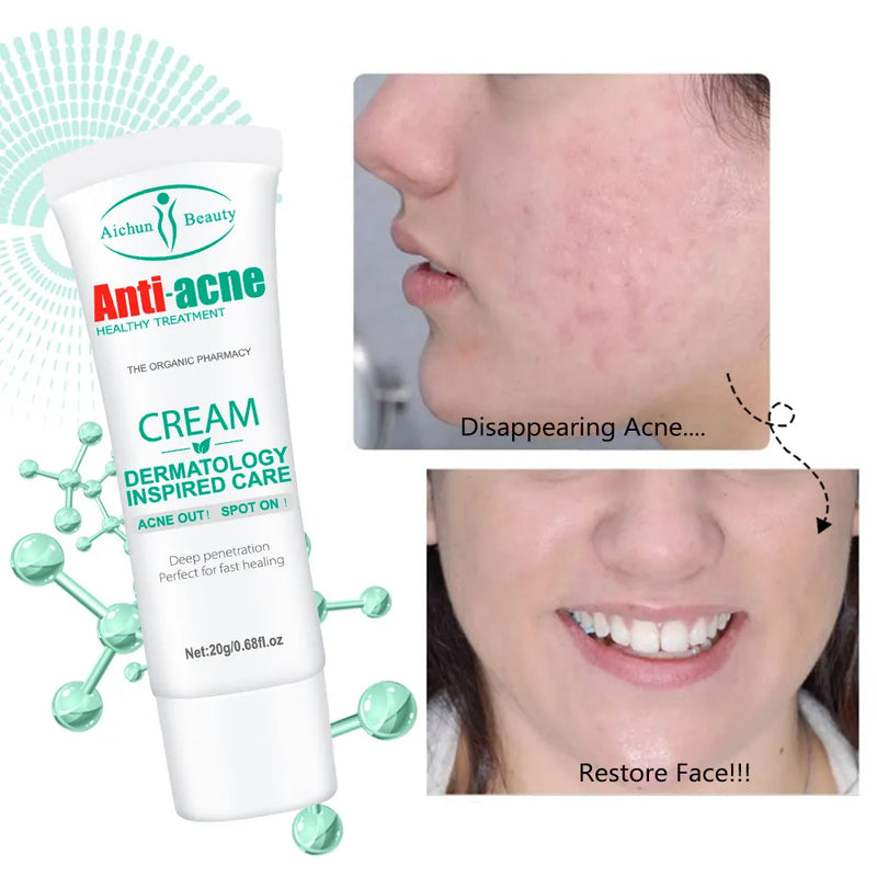 Anti Acne Face Cream for Acne & Blemish, Acne Spot and Acne scars Treatment