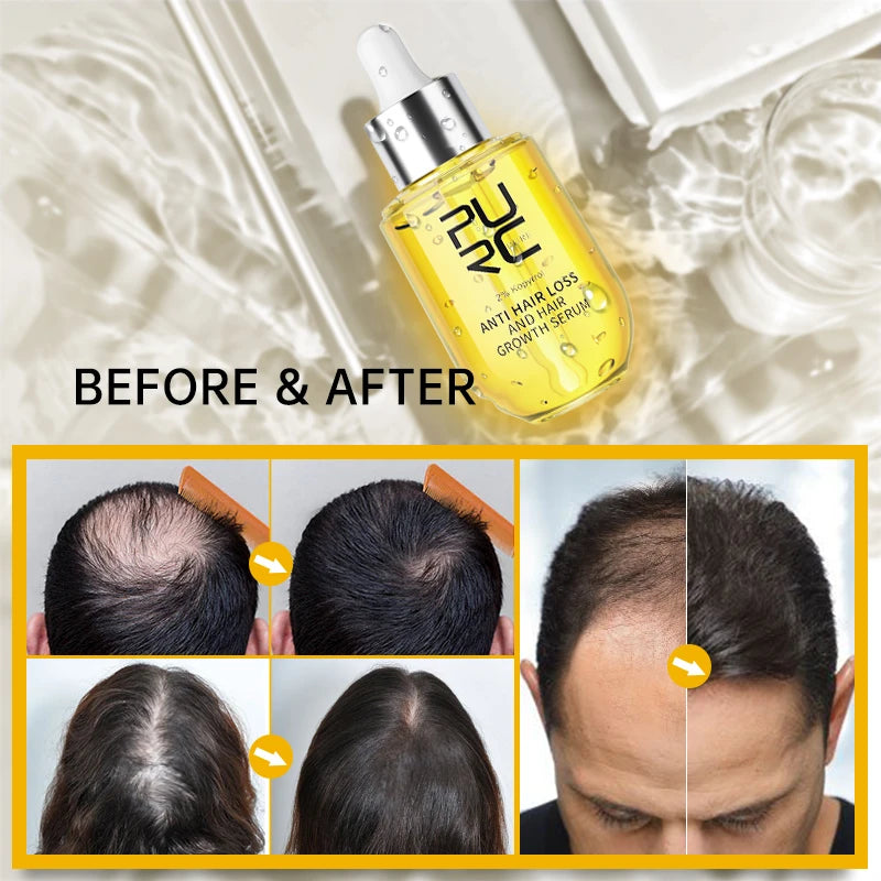 PURC Anti Hair Loss and Hair Growth Serum for Men and Women